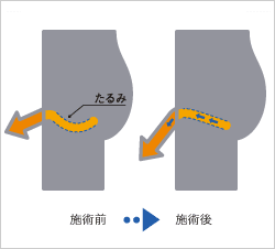 亀頭増大・強化術・陰茎増大・早漏治療 | 診療内容 | 熊本の美容外科・美容整形のハニークリニック