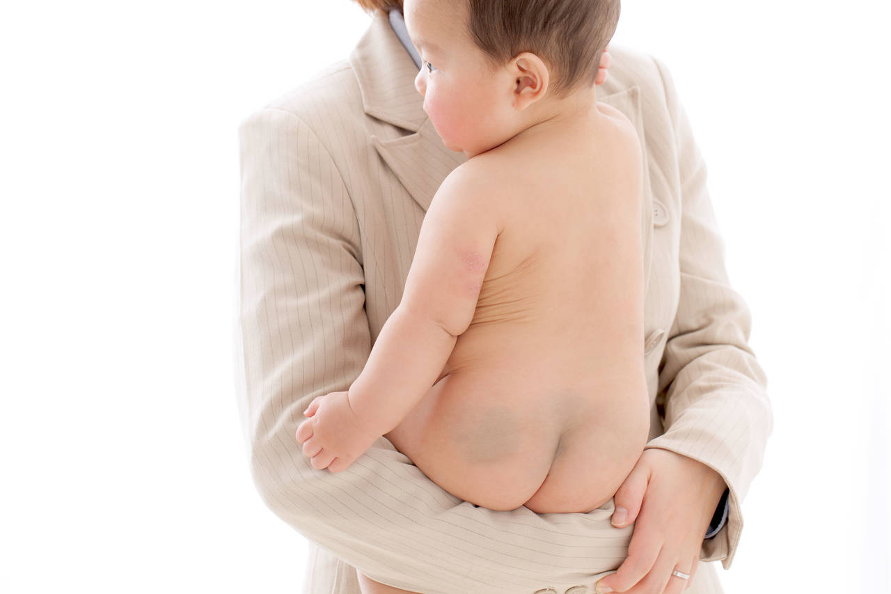 青あざ 異所性蒙古斑・太田母斑 の治療日本医科大学武蔵小杉病院