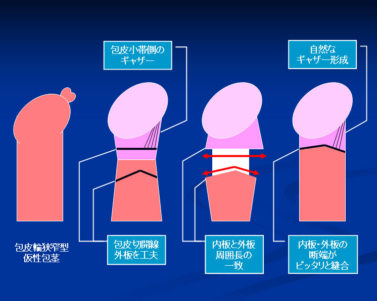 包茎「おちんちんの皮についてのお話し」｜にじいろ子どもクリニック｜小児科