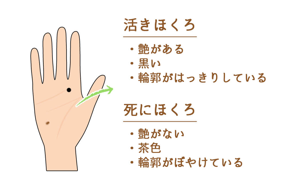 赤ちゃんのホクロとメラノーマについて