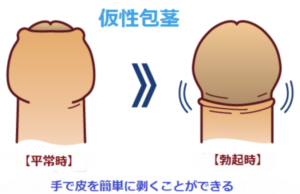 ドリチンとは？ドリチンのデメリットと最善の治療法を徹底解説 | 【フェアクリニック】包茎・薄毛・男の悩み相談所