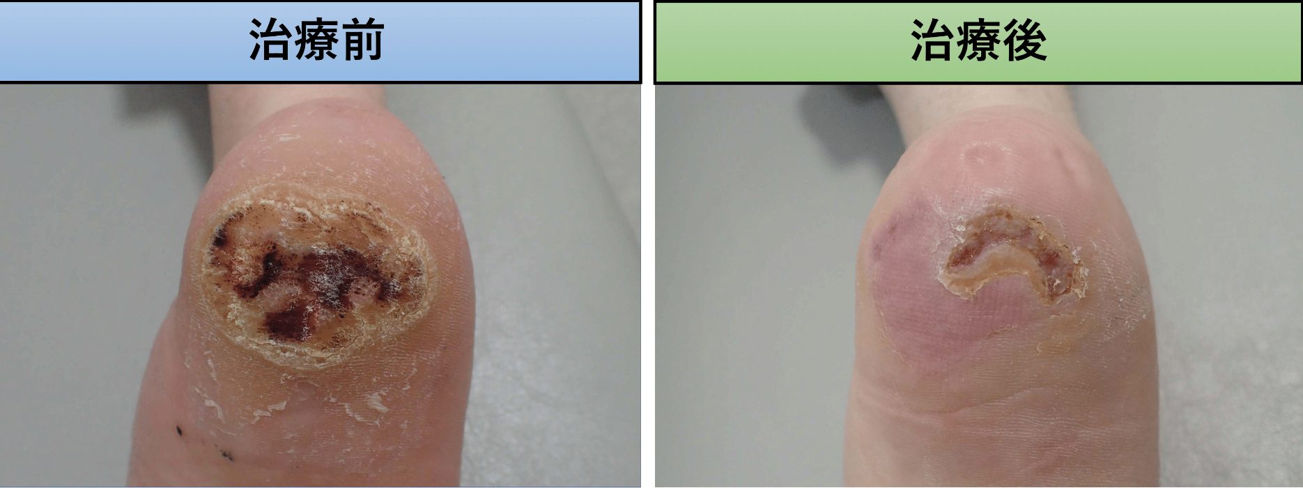 足裏の大きく治療困難なウイルス性いぼ大和駅前いなば皮膚科 旧名：大和駅前皮フ科スキンクリニック