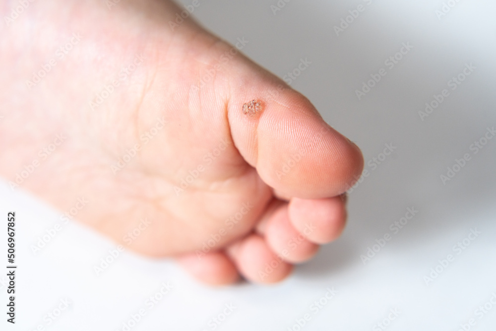 魚の目・芯治療大森・大木皮膚科 芯出し痛くない取り方は？