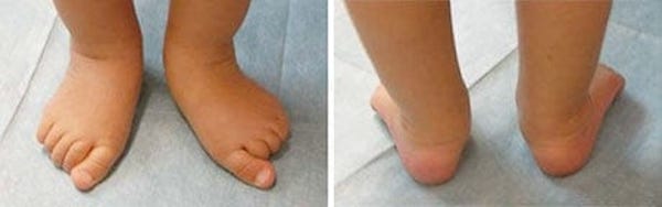 赤ちゃんの足トラブル・ゆがみを起こさない為にできること