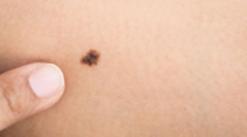 手相 手のひらのほくろ意味があるの？ 教えてまゆみ先生！第56回手相の素朴な疑問開運のコツ手相占いpalm reading- YouTube