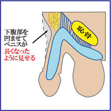 男性器 長茎術 |