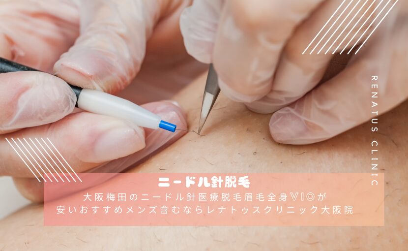 メンズ脱毛（医療レーザー） は大阪梅田【エースクリニック】HEPナビオ院