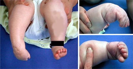 赤ちゃんの爪の反り返り 赤ちゃんの心と体 ベビーカレンダー専門家相談