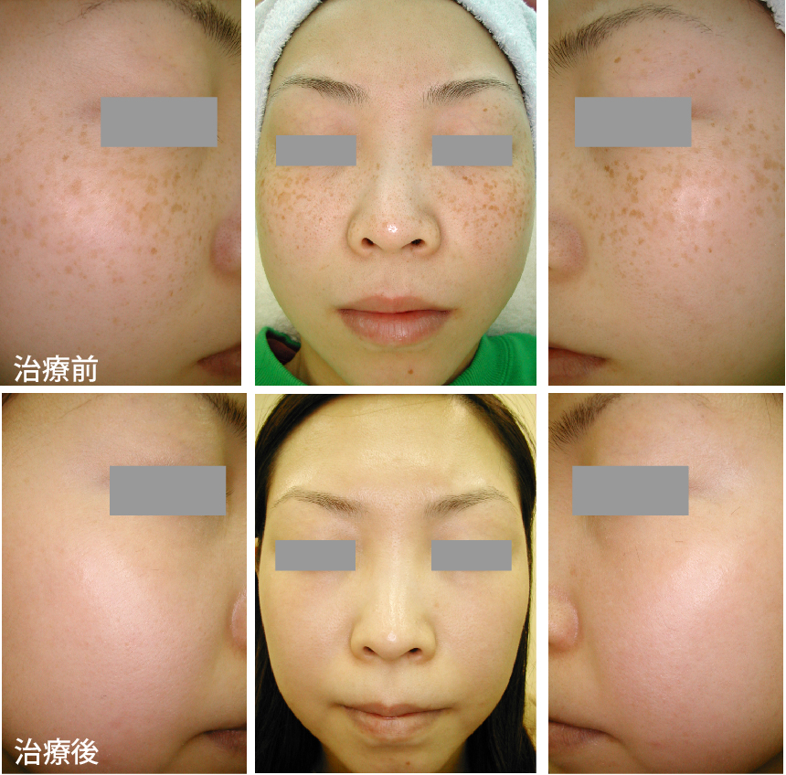 子供のそばかす取りレーザー梶田尚美オフィシャルブログ「Dr.703の休診時間」Powered by Ameba