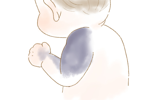 青あざの治療 〜異所性蒙古斑・太田母斑