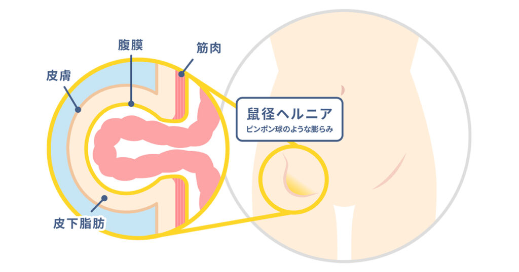 八王子市の鼠径ヘルニア(そけいヘルニア)/脱腸の専門治療が可能な病院(東京都) 5件 【病院なび】