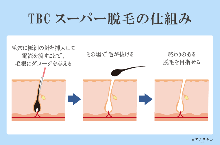 公式】スーパー脱毛｜男性向け脱毛｜MEN'STBC