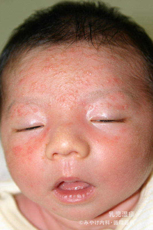 乳児湿疹 兄弟でも全然違う 汗- 東京の産後ケアサービス「産後ママたすけ隊」