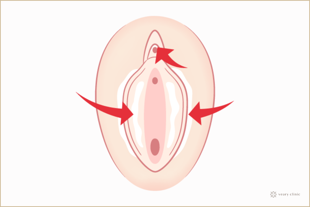 女性の包茎とは？クリトリス包茎における一般的な悩みと対処法 - アトムクリニック -