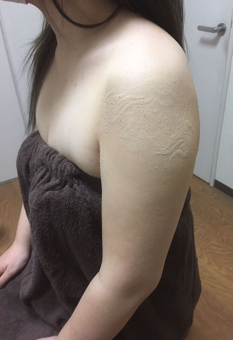 結婚式当日の早朝に、タトゥーカバー＆ボディ メイク 背中、二の腕のニキビ痕隠し の施術をさせていただきました♪施術後の仕上がりには、とても喜んでいただけてよかったです♪ この度のご利用誠にありがとうございました♪タトゥーカバータトゥー隠し大阪