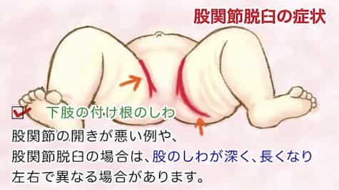 小児科医ママが解説おうちで健診：股関節脱臼。おうちで見られるポイントは？シワに左右差があるけど脱臼なの？2児ママ@小児科医