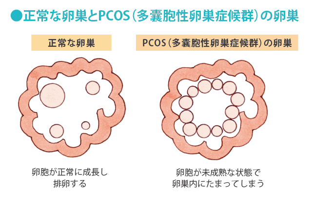 排卵日や妊娠によって変化する「おりもの」の特徴！ - 新型出生前診断 NIPT