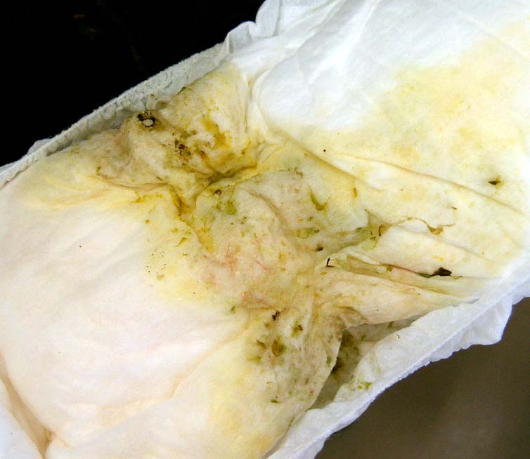 白い便が数日続くのは、胆道がんなどのサインかも医療・健康Tips毎日新聞「医療プレミア」