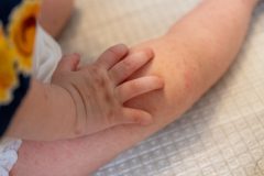 手のひらのほくろで占おう！死にほくろ・活きほくろの意味やほくろの位置ごとの運勢