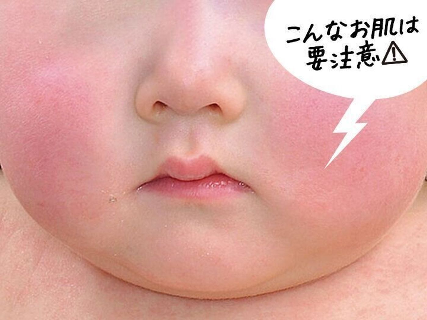 乳児脂漏性湿疹 皮膚炎 の原因＆対処法薬局・薬店で相談できる皮膚トラブルヒフシルワカル