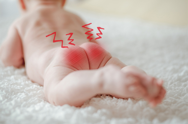 赤ちゃんのお尻 赤ちゃんの病気・ケガ ベビーカレンダー専門家相談