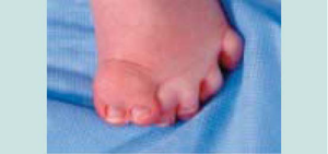 赤ちゃん・幼児の爪 Ｖ字に反る 変形・欠け・剥がれ1歳9ヶ月- ぼにょ朗育児日記