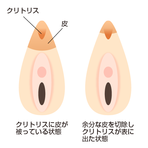 クリトリス包茎とは？悩みを解決する切除手術のメリットやリスクを解説 | コラム一覧｜ 