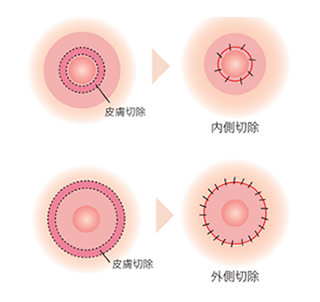 Amazon.co.jp: MiHaruTsu 陥没乳首 乳頭補正器 扁平