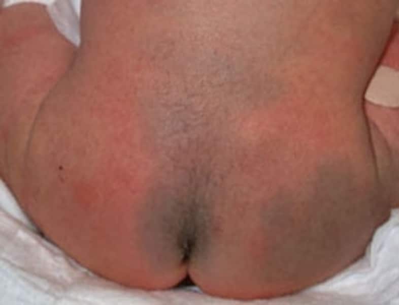 蒙古斑はなぜできるのか 日本人 アジア人 に多い原因皮膚・爪・髪の病気All About