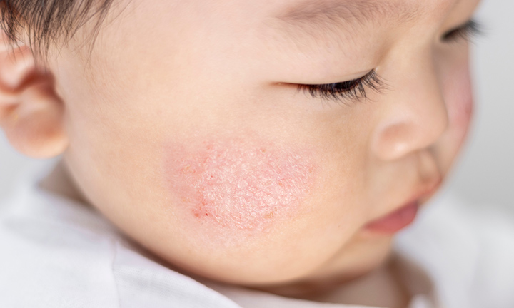 赤ちゃんが乳児湿疹にならないための予防方法 - すこやかなお肌を育むスキンケア