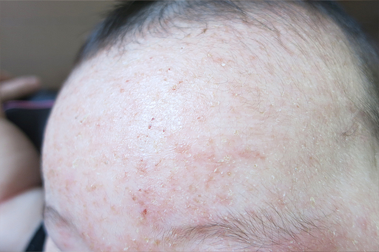 赤ちゃんのアトピー性皮膚炎を知ろう ―将来、健康な肌を保つためにできること 公式 ALOBABY アロベビー