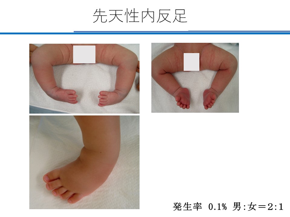 赤ちゃんの足の爪が反り返っている！？育児はズボラぐらいがちょうどいい