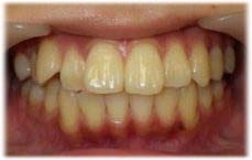 大きい前歯！GANREF