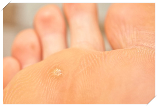 イボとミズイボ、ウオノメとタコ─どう違うのですか？─ Q11 - 皮膚科Q＆A 公益社団法人日本皮膚科学会