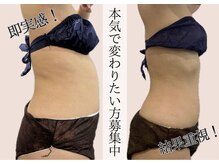 大阪で痩身エステをお探しの方におすすめしたいダイエットエステサロン