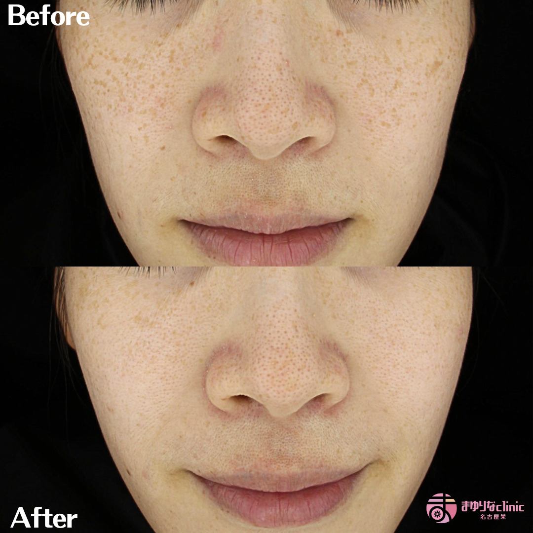 そばかすがコンプレックス！？日本人にそばかすができるのは珍しい？チュラコスの美活予備校