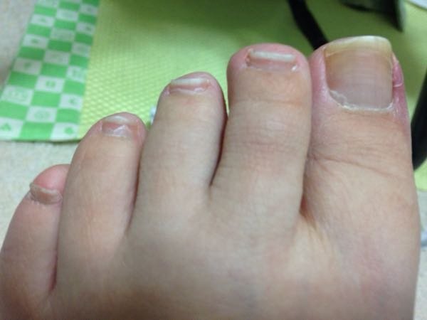 下の娘の爪が腫れた話わかばひふ科クリニック 東京都武蔵野市吉祥寺東町