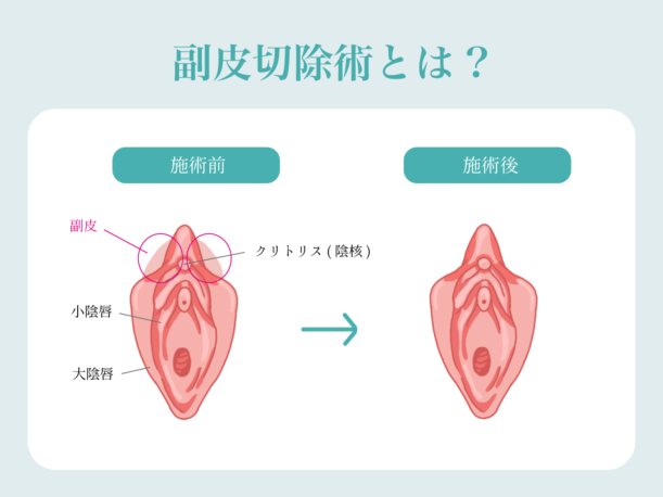 クリトリス包茎 | 婦人科形成