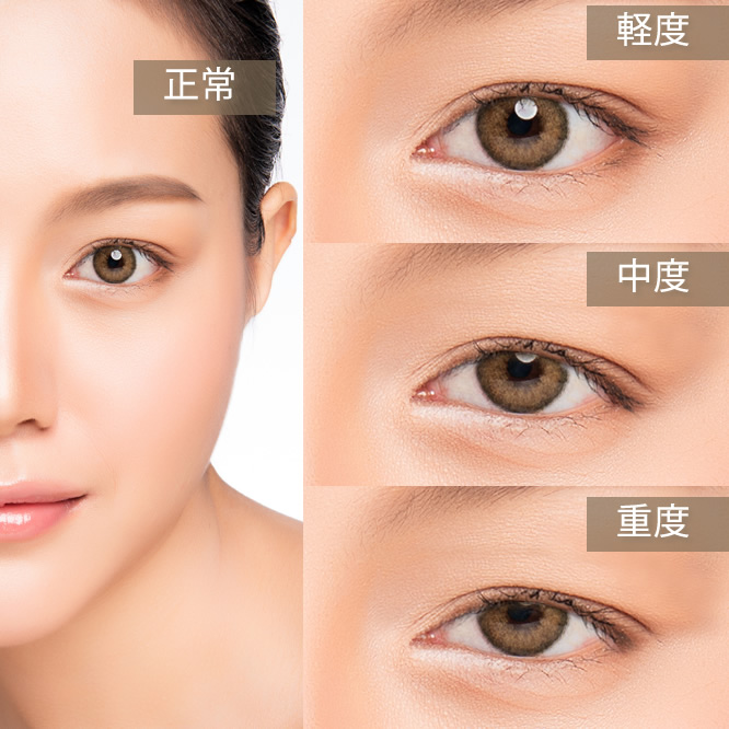 これで出目か奥目かわかりますか？ - 別に普通だと思いますが横顔だけなの- Yahoo!知恵袋