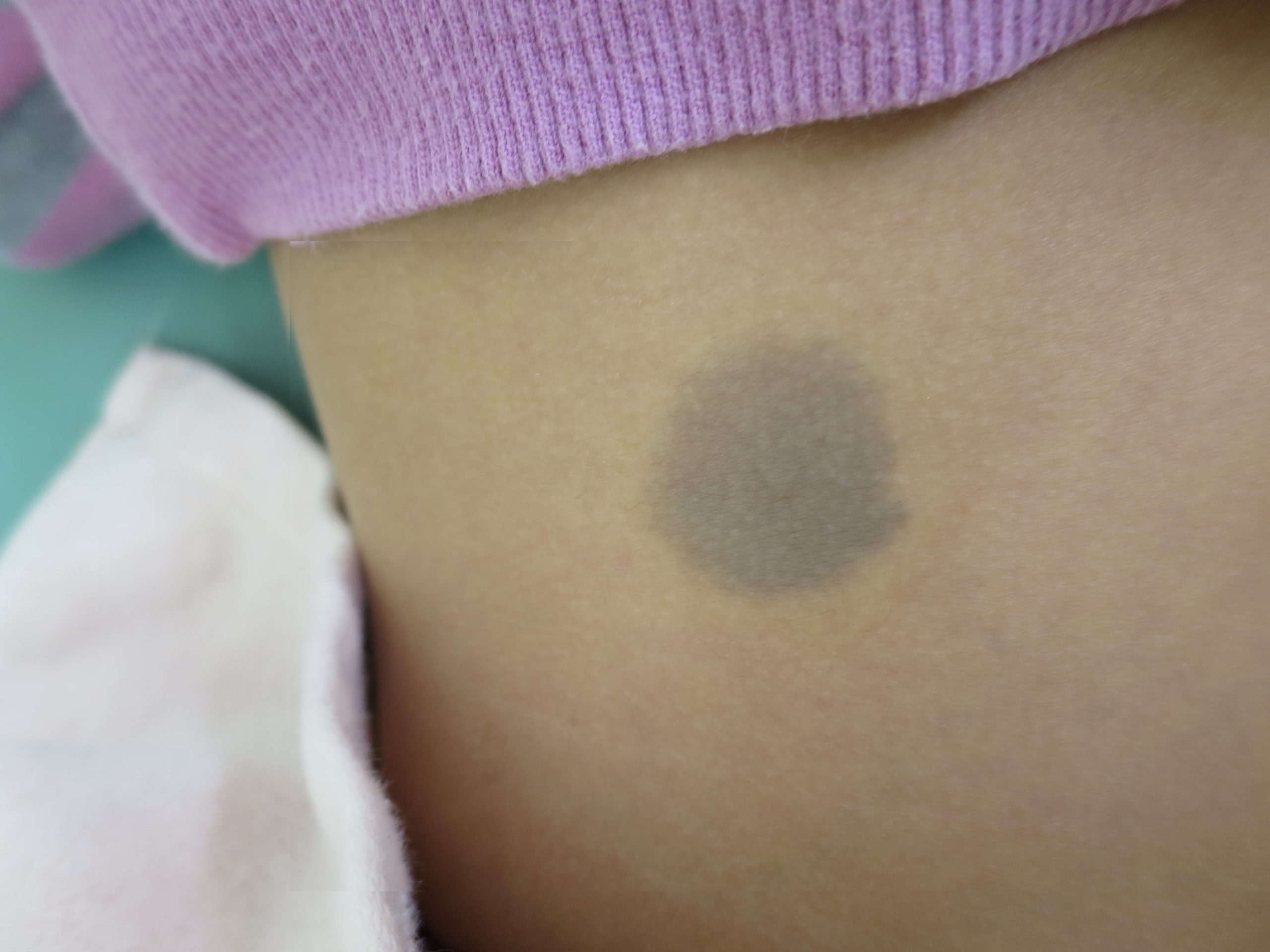 異所性蒙古斑赤ちゃん・子供のあざ治療なら最新レーザー治療×形成外科専門医の大阪梅田形成クリニック