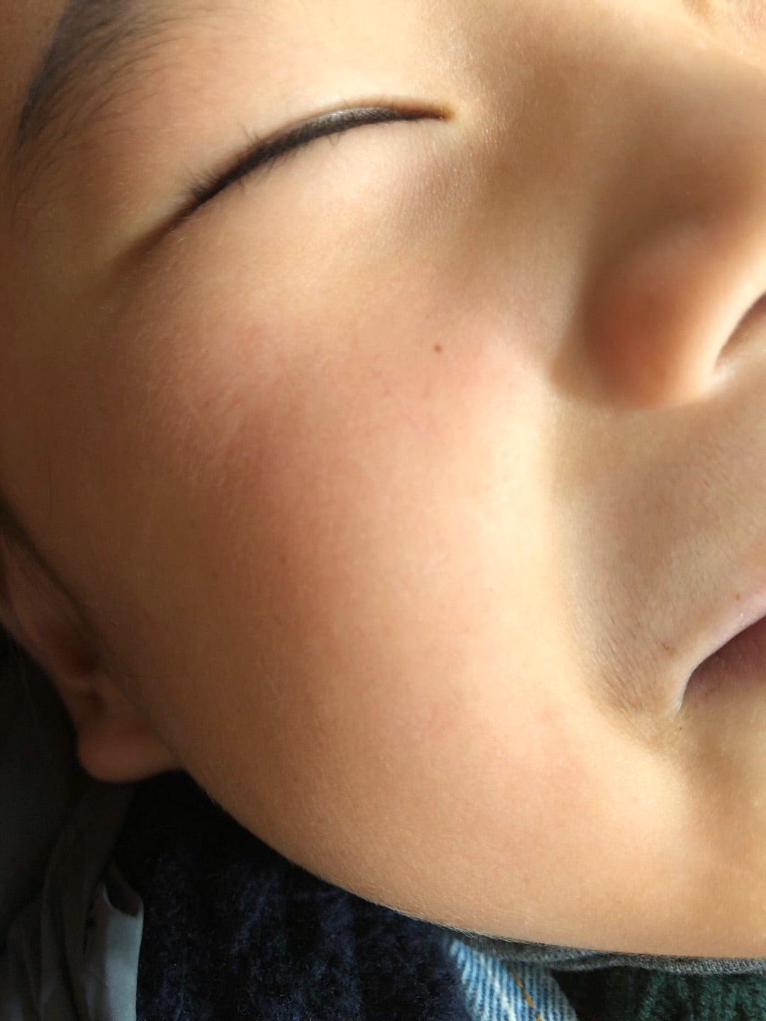 そばかすを消したい！そばかすの原因と5つの治療法