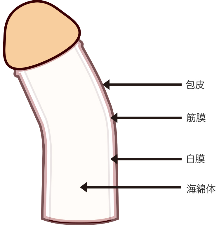 症例13 49歳男性 ペニス上反り形成術・屈曲ペニス修正術・包茎手術