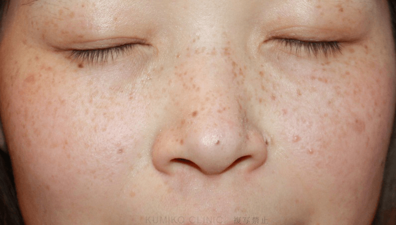 朝の2粒で、未来のシミ・そばかす対策☀️✨, しかも今回は“外からも内からも”ケアできる最強セット！, ホワイトルマン＋日焼け止めが通常12,890円→ 初回なんと **890円 税込 **😳, 『シミ』か『そばかす』ってコメントしてみて！いいことあるよ！, これ、ホワイトルマン史上日本一お得なキャンペーン。, もちろん定期縛りなしだから、安心してサクッと試せるよ🙆‍♀️, キャンペーンは