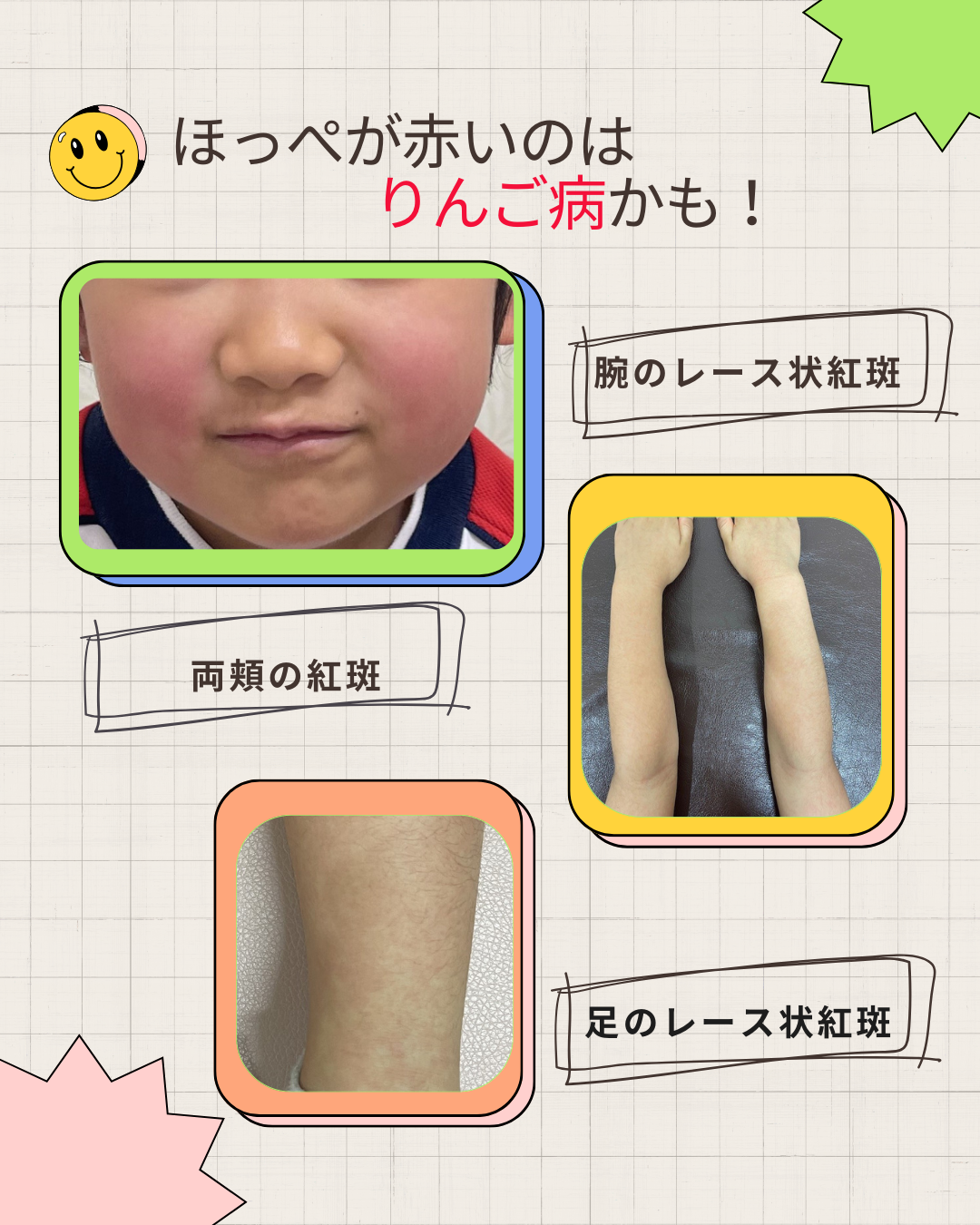 赤ちゃんのほっぺが赤いのは乾燥のサイン！たっぷり保湿で肌を守ろうナチュラルサイエンス for Mama & Kids Smile