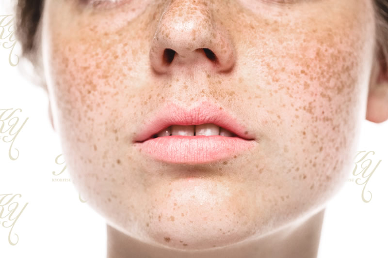 子供の頃からのそばかす・シミを綺麗にしてみませんか？肌と歯のクリニック 東京ベイ幕張千葉 美容皮膚科