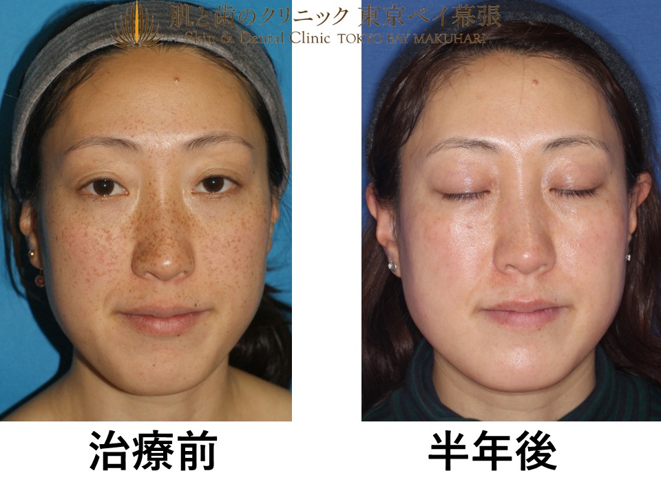 美容外科医監修 なぜ日本人はそばかすができにくい？原因や予防法、対応策を解説公式コラム美容整形・二重整形なら共立美容外科