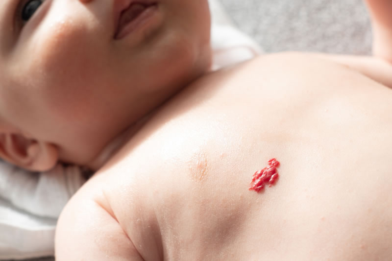 異所性蒙古斑赤ちゃん・子供のあざ治療なら最新レーザー治療×形成外科専門医の大阪梅田形成クリニック