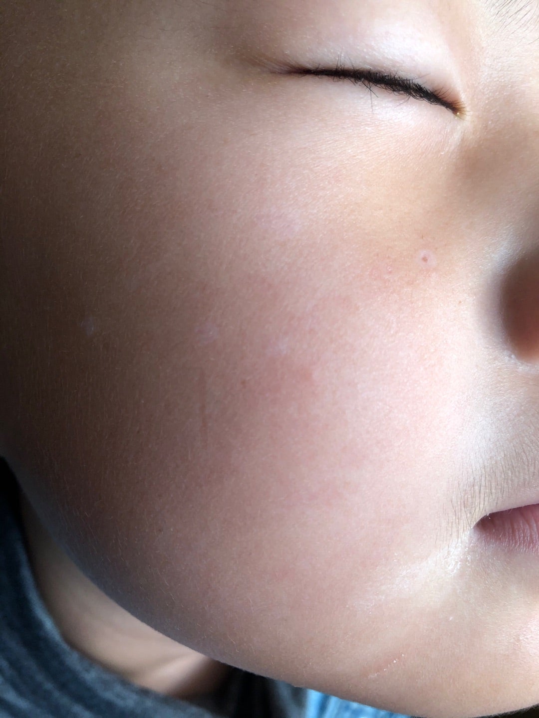 ４０代 子供の頃から悩みだった そばかすを改善最短４ヶ月でシミ改善エステティックブルジョン 三島,沼津,裾野,富士,静岡,浜松,横浜エリア対応