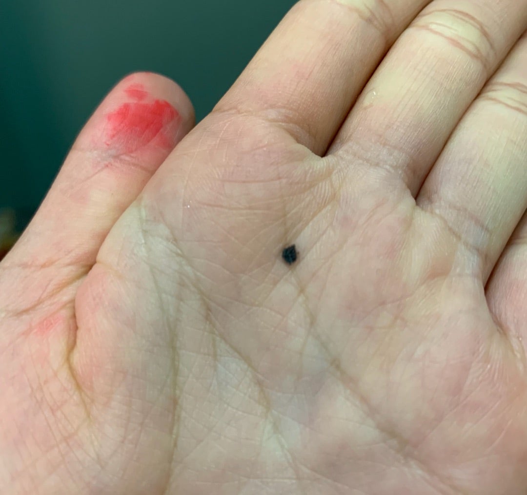 ウイルス性イボ尋常性疣贅- 上野御徒町ファラド皮膚科