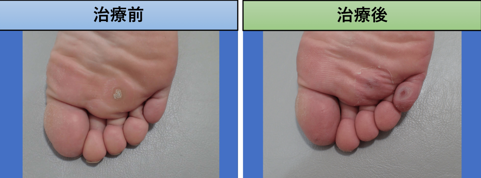 いぼ大田区大森・大木皮膚科 尋常性疣贅・イボ治療専門外来